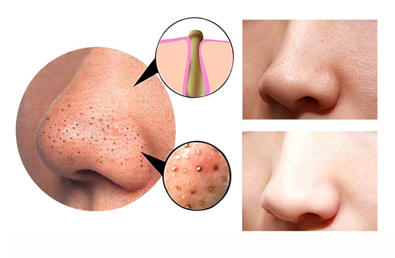 4 in 1 Body and Facial Cupping Blackhead Remover Machine
